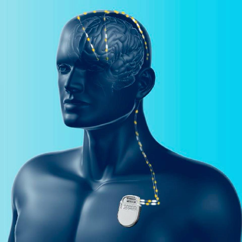 Estimulación cerebral profunda (DBS) – Vista general - Médica Sur Copyright